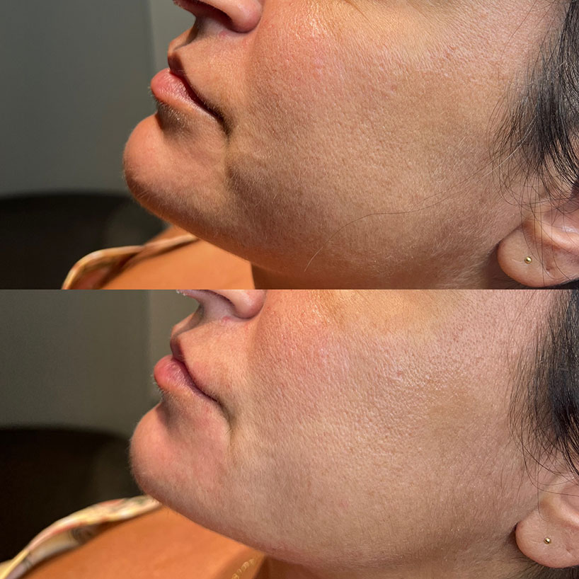 before-after-chin-filler-estero-laser-lounge-patient-02