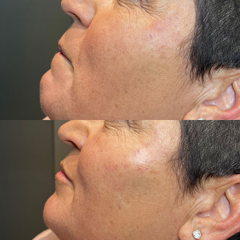 before-after-chin-filler-estero-laser-lounge-patient-03
