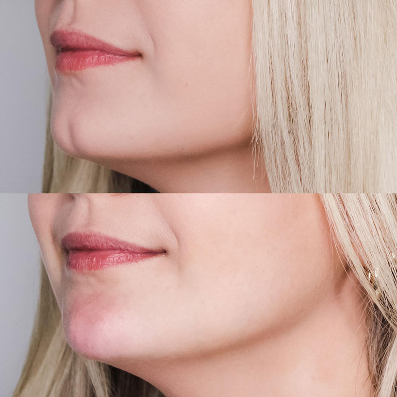 before-after-chin-filler-estero-laser-lounge