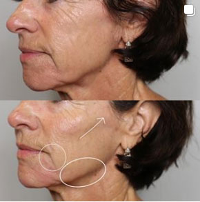 before-after-estero-laser-lounge-patient-01