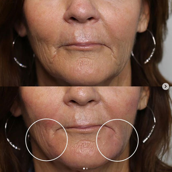 before-after-estero-laser-lounge-patient-02
