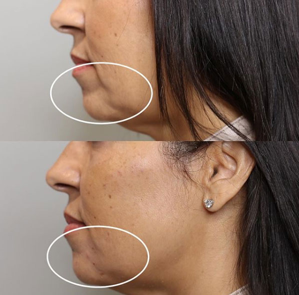 before-after-estero-laser-lounge-patient-03