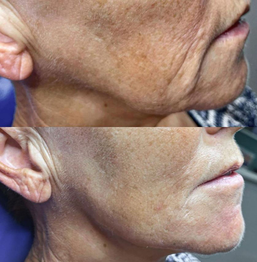 before-after-estero-laser-lounge-patient-05
