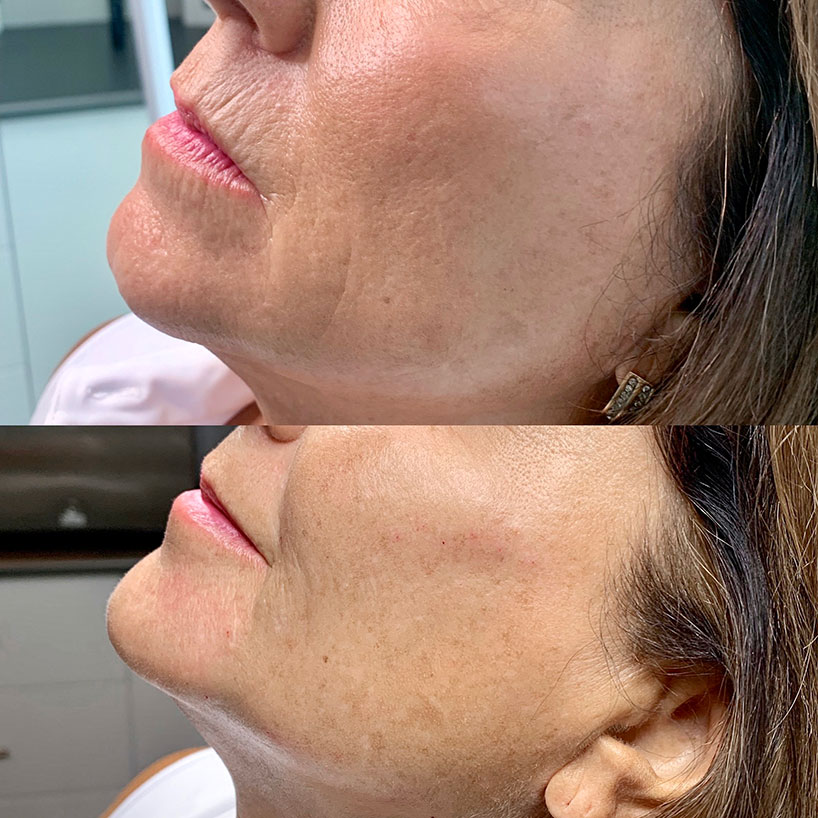 before-after-estero-laser-lounge-patient-06
