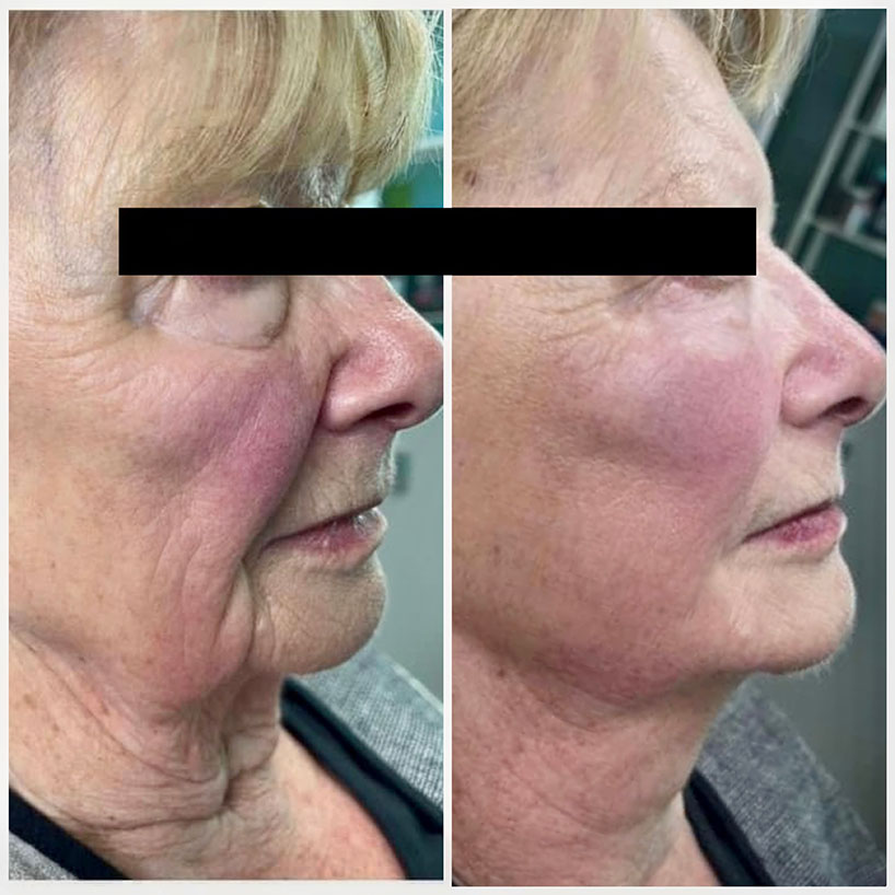 before-after-estero-laser-lounge-patient-08