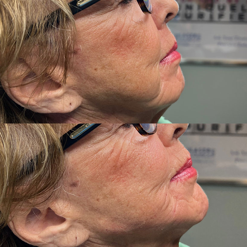 before-after-estero-laser-lounge-patient-09