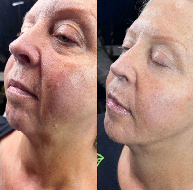 before-after-estero-laser-lounge-patient-12
