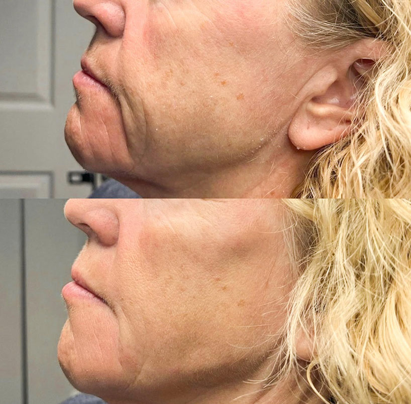 before-after-estero-laser-lounge-patient-13