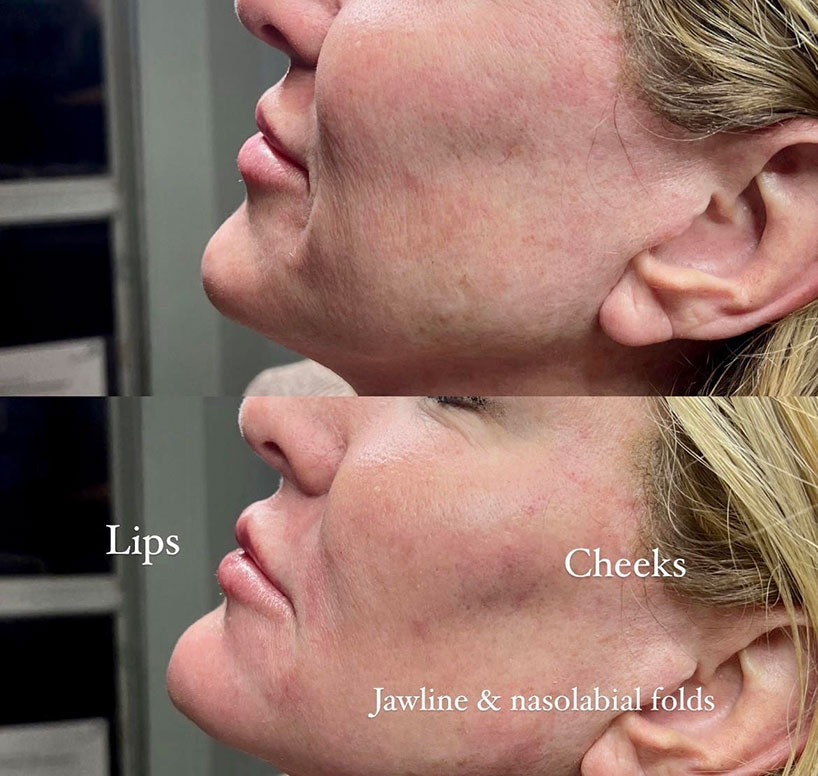 before-after-estero-laser-lounge-patient-14
