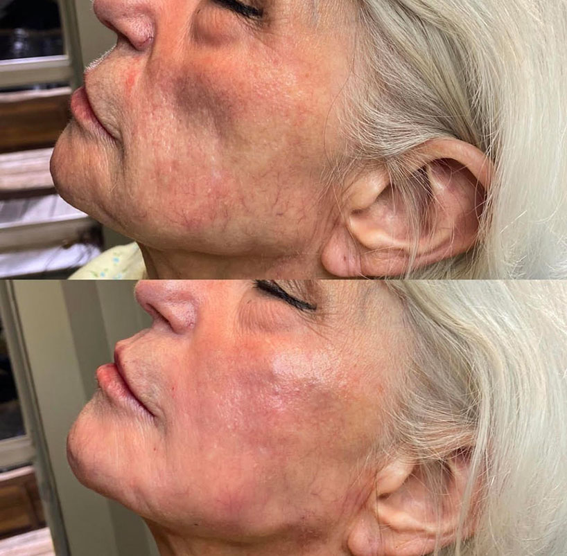 before-after-estero-laser-lounge-patient-15
