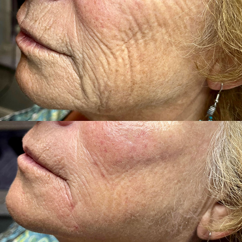 before-after-estero-laser-lounge-patient-16