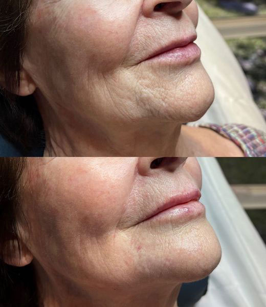 before-after-estero-laser-lounge-patient-18