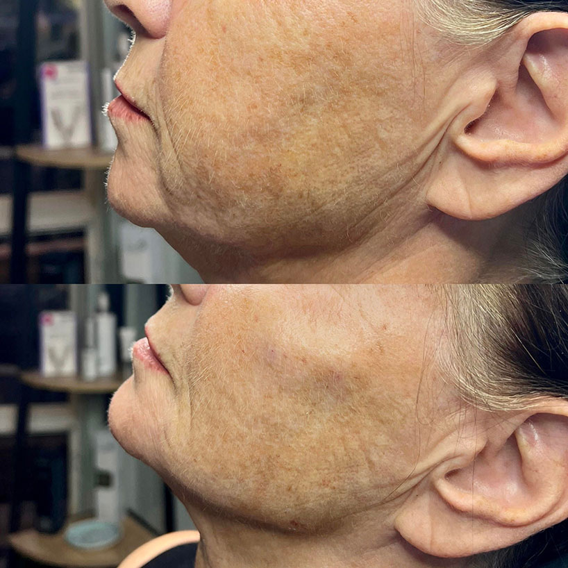 before-after-estero-laser-lounge-patient-20