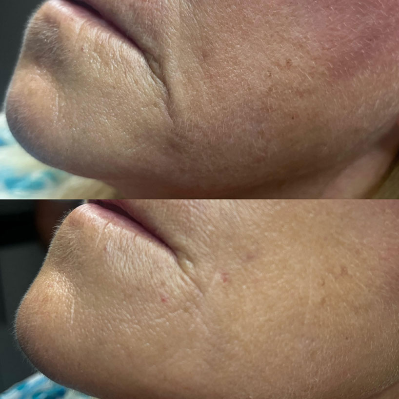 before-after-estero-laser-lounge-patient-21