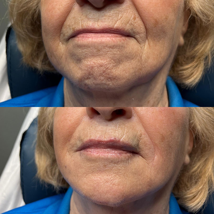 before-after-estero-laser-lounge-patient-22
