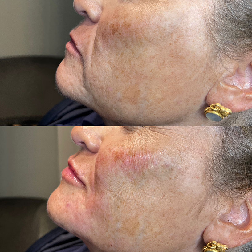 before-after-filler-estero-laser-lounge-patient-05