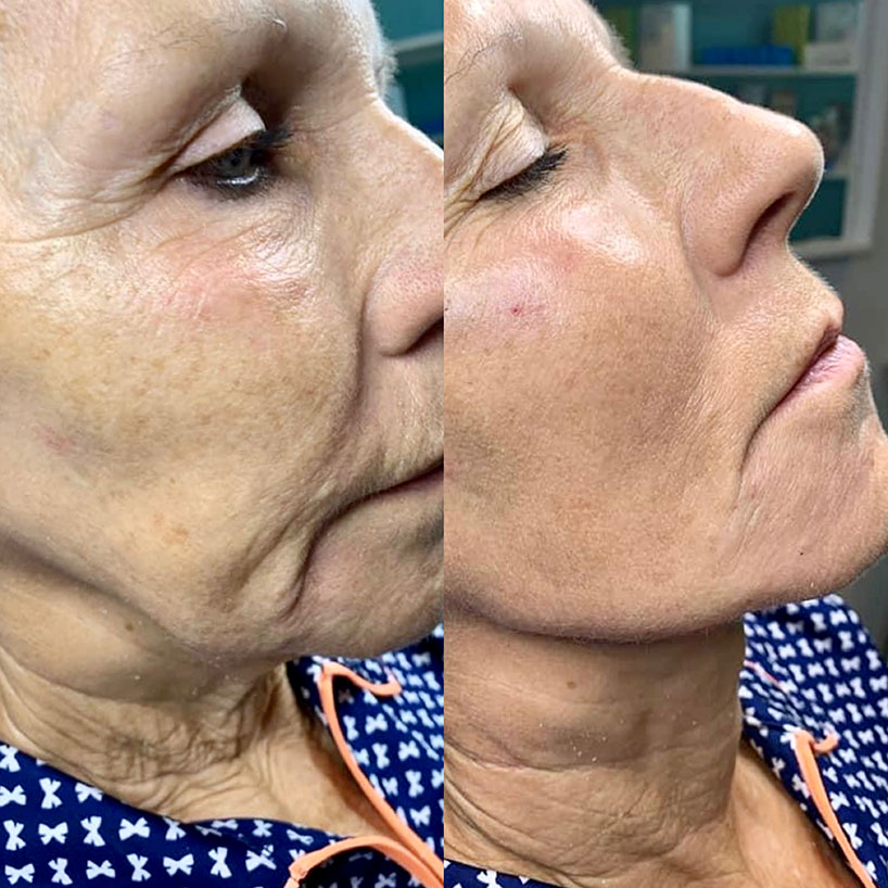 before-after-filler-estero-laser-lounge-patient-06