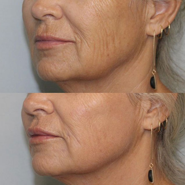 before-after-filler-estero-laser-lounge-patient-07