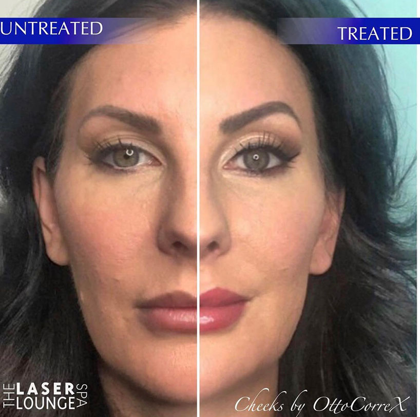 before-after-fillers-cheeks-laser-lounge-spa