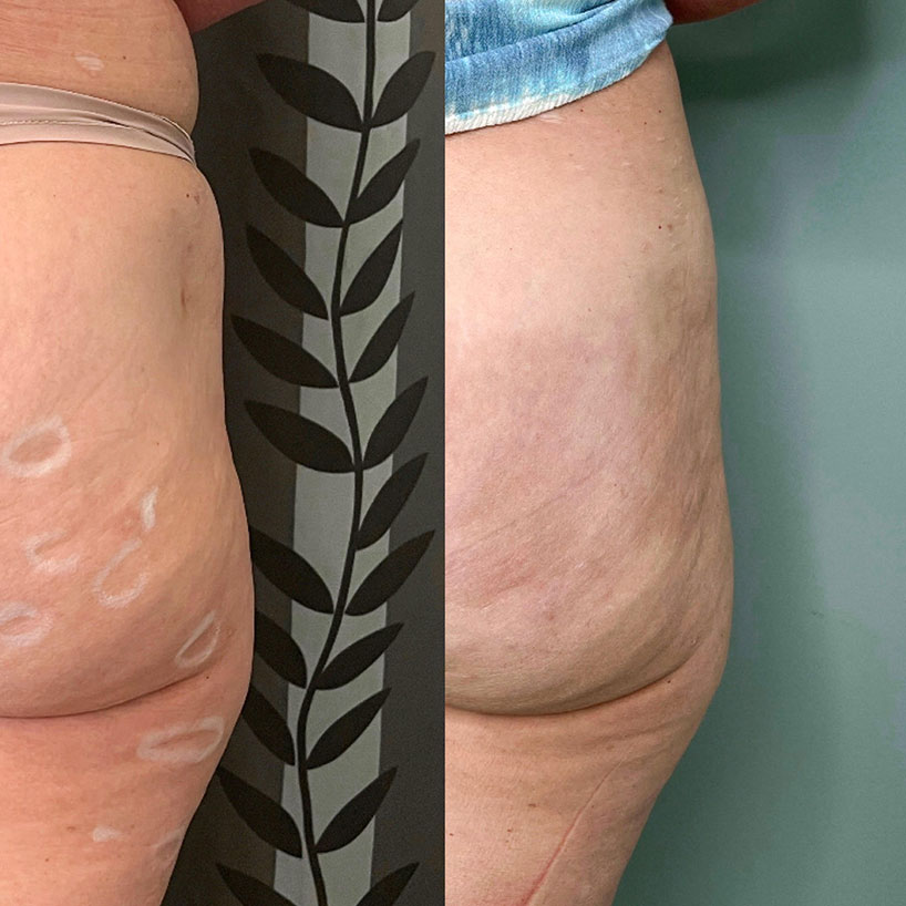 butt-filler-side-before-after-laser-lounge-spa-estero