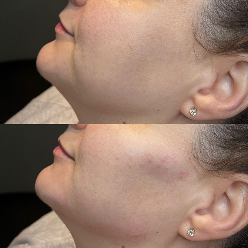 cheek-filler-before-after-laser-lounge-estero