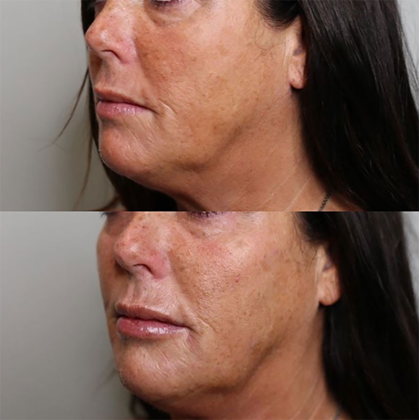 cheek-filler-before-after-laser-lounge-spa-estero