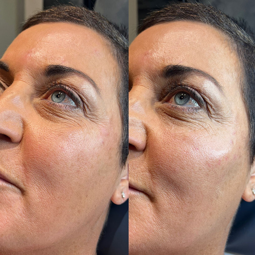 cheek-filler-estero-before-after-laser-lounge
