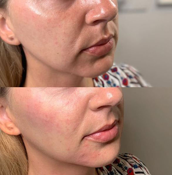 cheek-fillers-laser-lounge-spa-estero-before-after