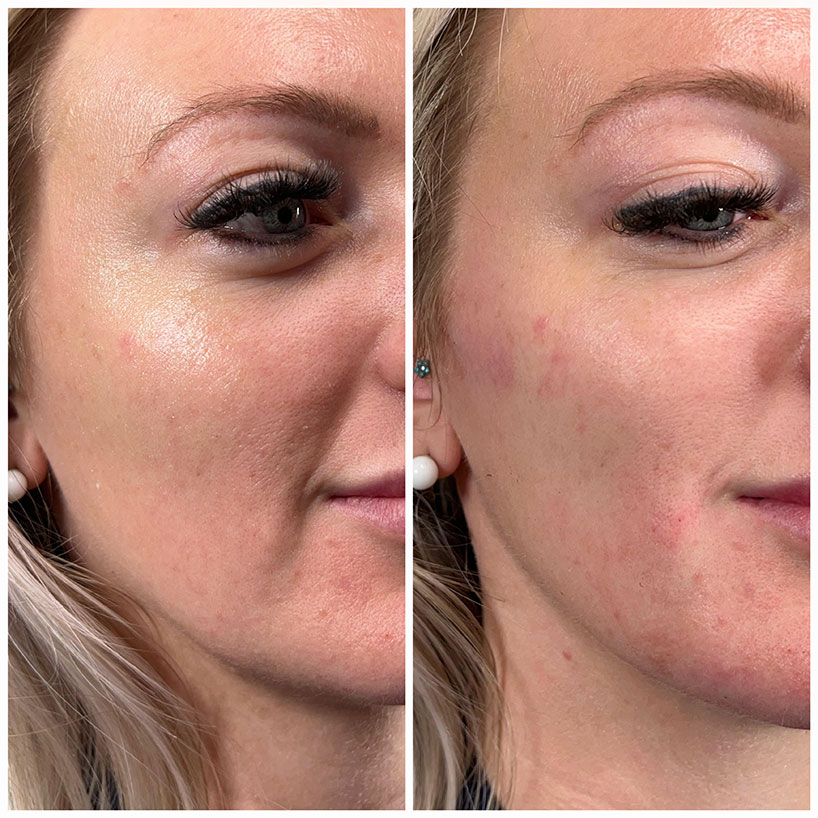 cheek-fillers-laser-lounge-spa-estero