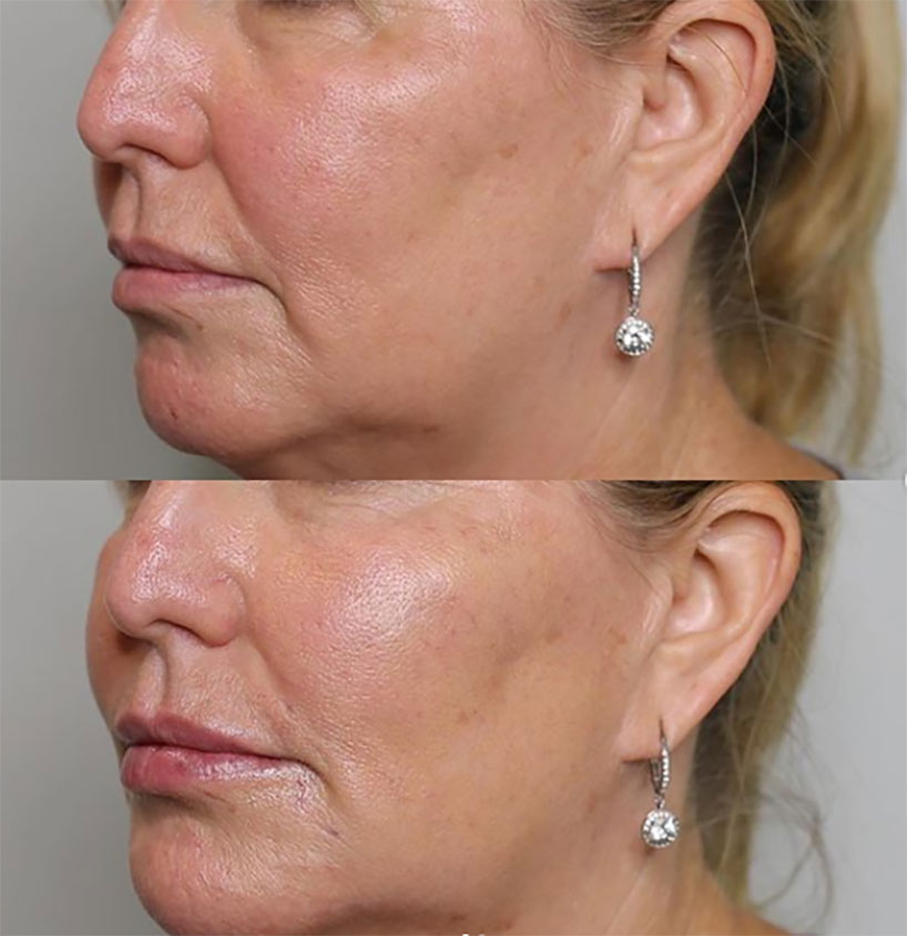 cheeks-filler-before-after-laser-lounge-spa-estero