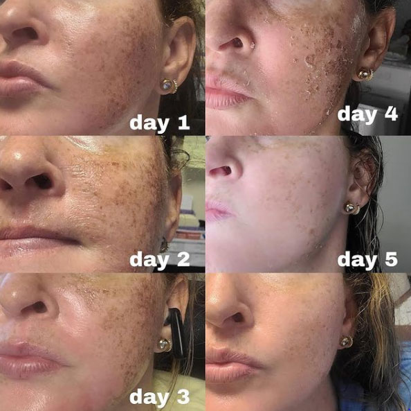 chemical-peel-before-and-after-the-laser-lounge-spa-estero