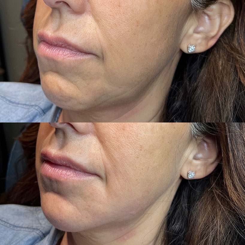 chin-filler-before-after-laser-lounge-estero