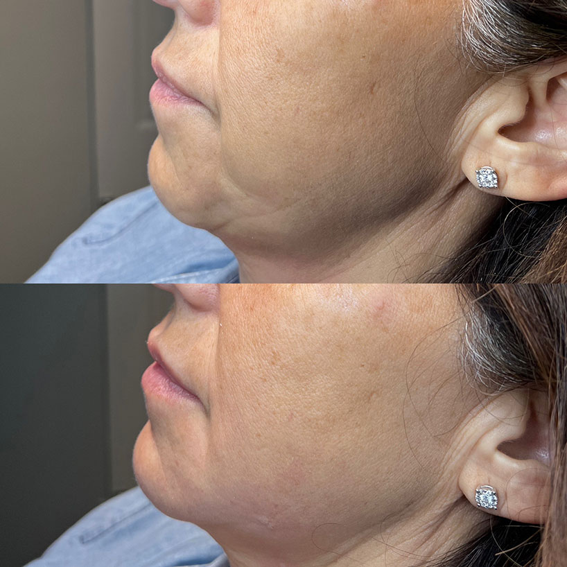chin-filler-laser-lounge-spa-before-after
