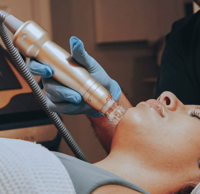 choose-us-for-rf-microneedling-estero-fl