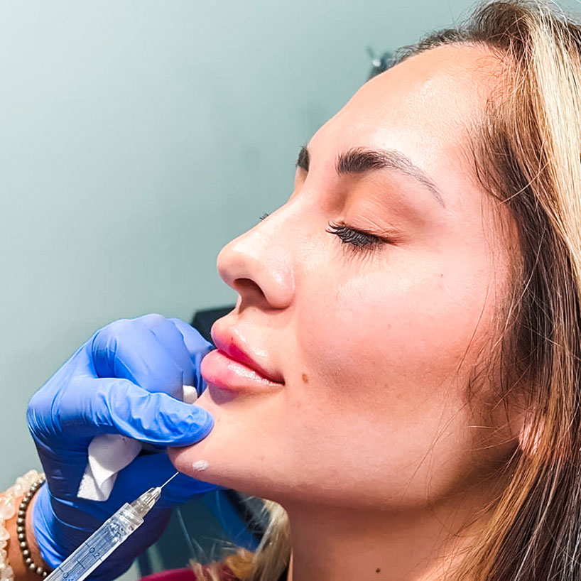 getting-chin-filler-laser-lounge-estero