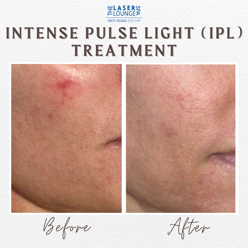 intense-pulse-light-treatment-laser-lounge-spa-estero