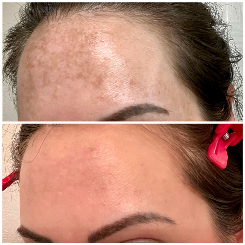ipl-forehead-laser-lounge-estero