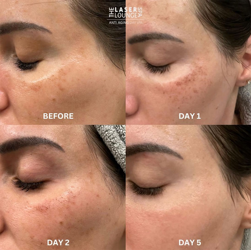 ipl-laser-cheek-laser-lounge-spa-estero