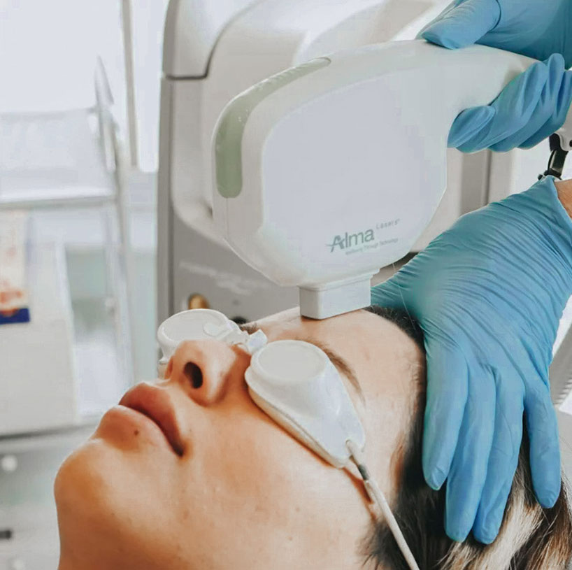 ipl-laser-device-laser-lounge-estero