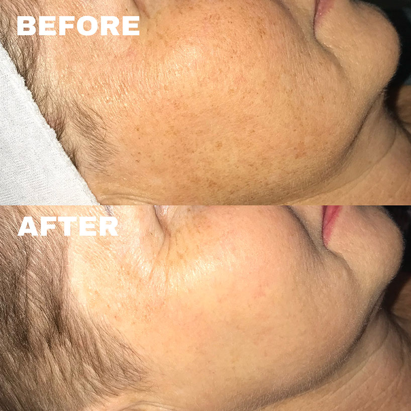 ipl-laser-lounge-estero-before-after