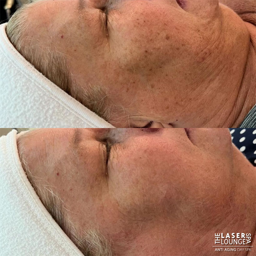 ipl-laser-pixel-laser-lounge-spa-estero