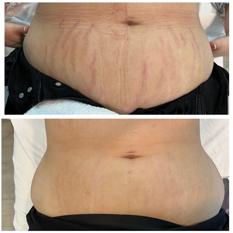 ipl-laser-treatment-for-stretchmarks-laser-lounge-spa-estero