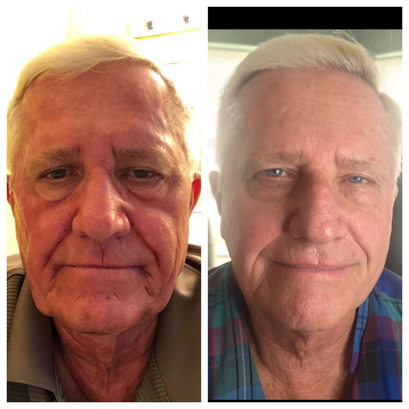 ipl-pixel-male-results-before-after