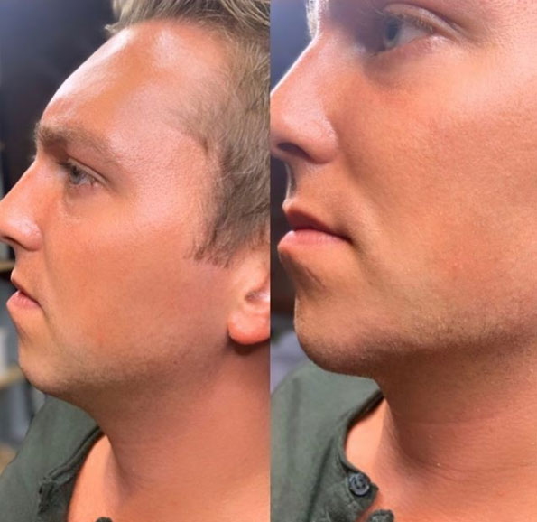 jaw-line-filler-refinement-laser-lounge-estero-10