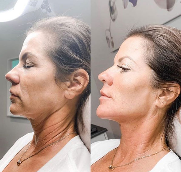 jaw-line-filler-refinement-laser-lounge-estero-11