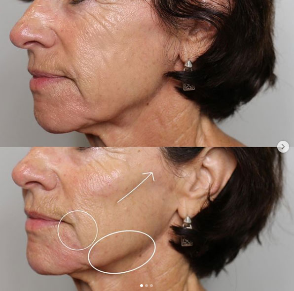 jaw-line-filler-refinement-laser-lounge-estero-12