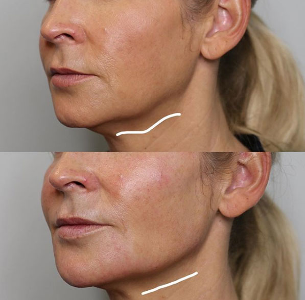 jaw-line-filler-refinement-laser-lounge-estero-13