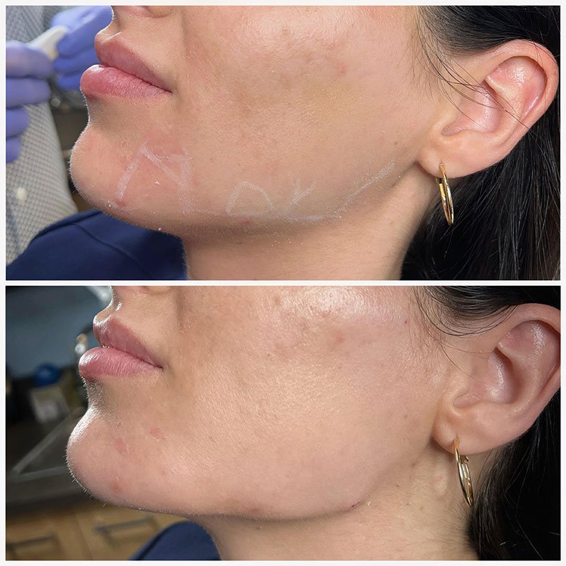 jaw-line-filler-refinement-laser-lounge-estero-14