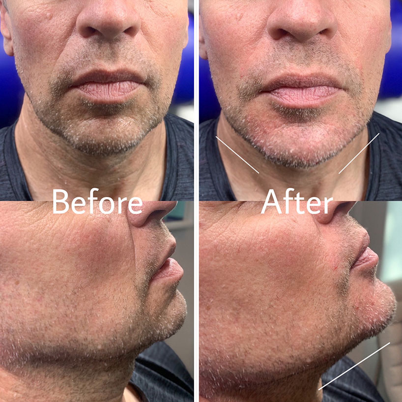 jaw-line-filler-refinement-laser-lounge-estero-16