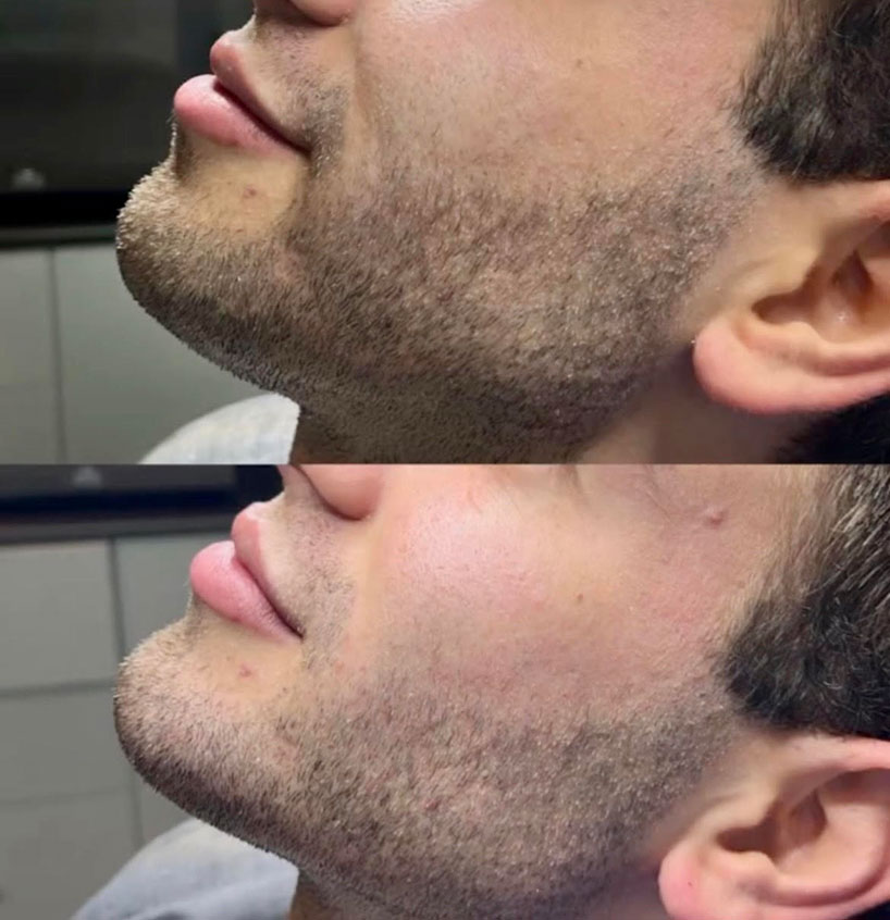 jaw-line-filler-refinement-laser-lounge-estero-18